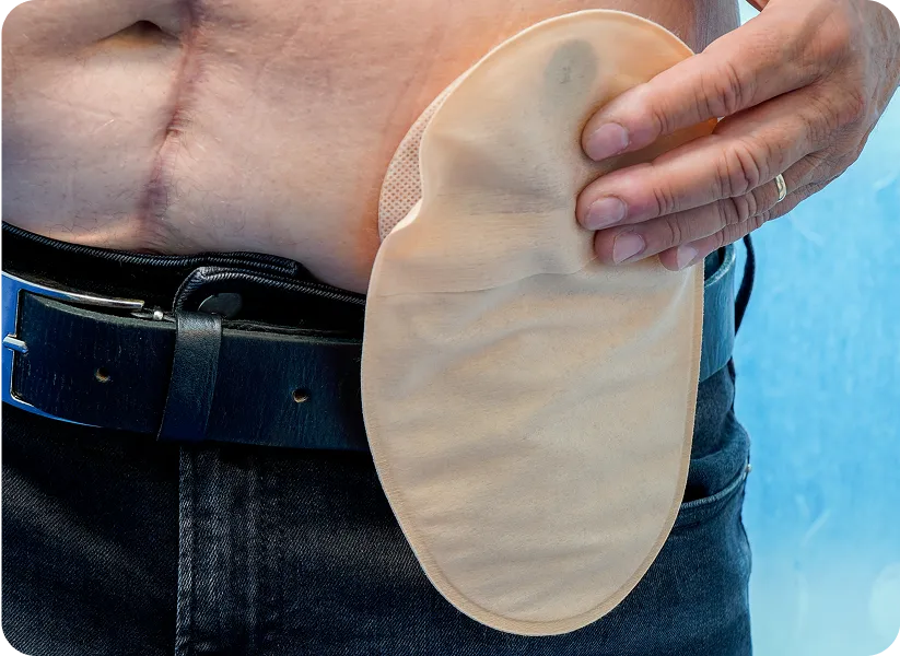 A person holding an ostomy pouch